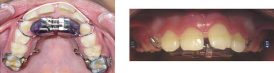 Fig. 1 Plano inclinado de acrílico con tornillo de expansión incorporado.