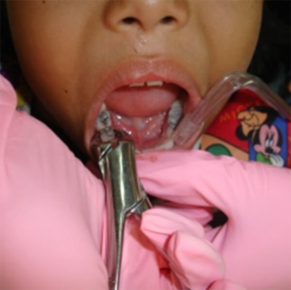 Fig. 3 Exodoncia de diente temporal Paciente Clínica Odontopediatría UGMA