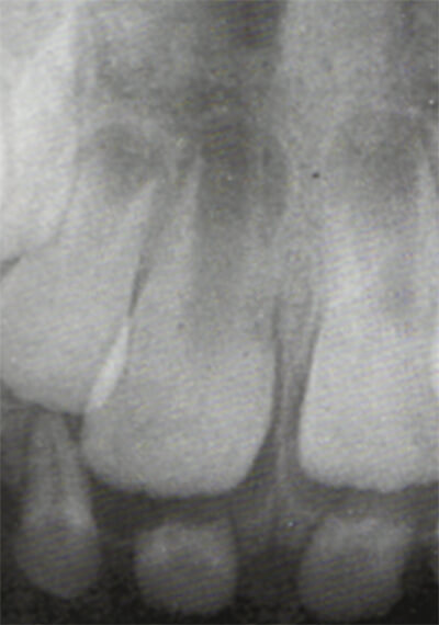 Fig. 4 Radiografía Periapical. Tomado de D' Escriván de Saturno. Ortodoncia en Dentición Mixta.