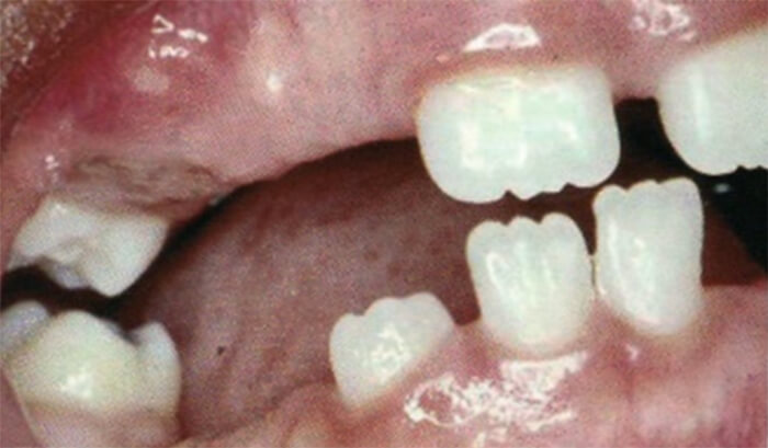 Fig. 5 Pérdida Prematura múltiple de dientes temporales Tomado de D' Escriván de Saturno. Ortodoncia en Dentición Mixta.