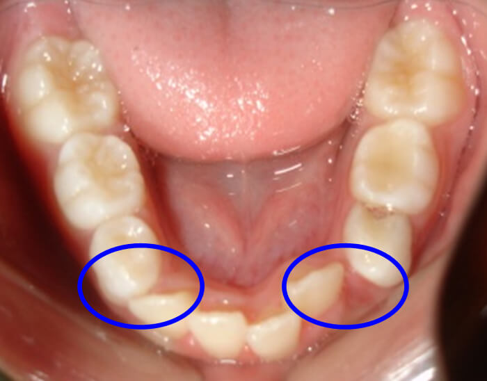 Fig. 6 Pérdida Prematura del 83 y 73 Paciente Clínica Odontopediatria UGMA