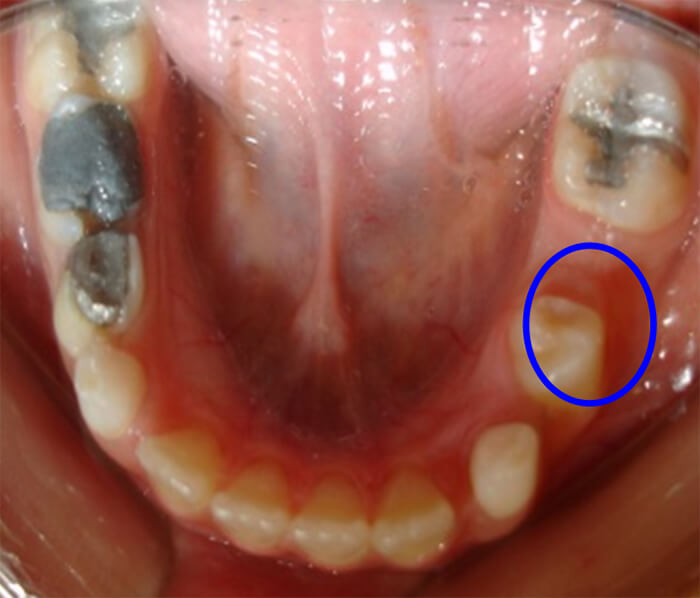 Fig. 7 Pérdida Prematura del 75 Paciente Clínica Odontopediatría UGMA