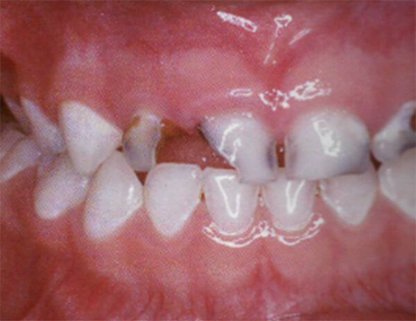 Fig. 8 Presencia de caries en el sector anterior. Tomado de D' Escriván de Saturno. Ortodoncia en Dentición Mixta