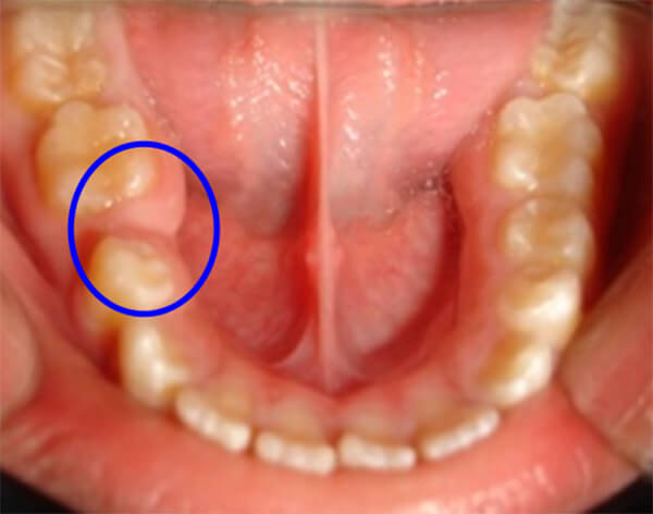 Fig. 11 Disminución del espacio del 45 y de la longitud del arco debido a la Pérdida Prematura del 85. Paciente Clínica Odontopediatria UGMA