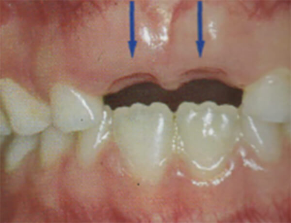 Fig. 12 Queratinización de la mucosa. Tomado de D' Escriván de Saturno. Ortodoncia en Dentición Mixta.