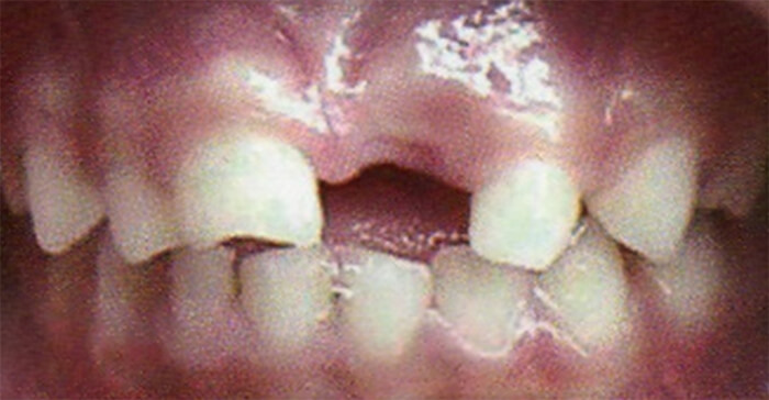 Fig. 13 Pérdida prematura de incisivo central superior izquierdo. Tomado de D' Escriván de Saturno. Ortodoncia en Dentición Mixta.