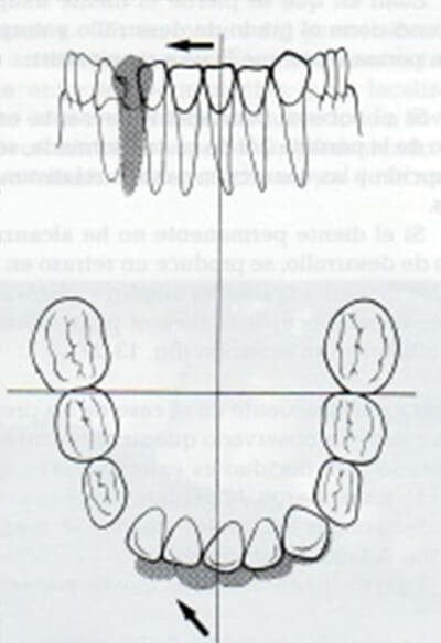 Fig. 14 Representación esquemática de la Pérdida Prematura del 83, con migración de los incisivos permanentes hacia el mismo lado. Tomado de Canut