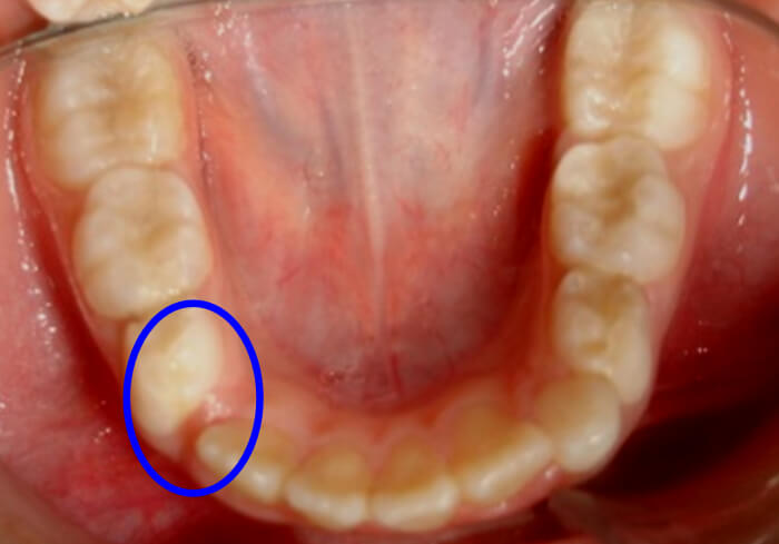 Fig. 15 Pérdida Prematura del 83 Paciente Clínica Odontopediatría UGMA