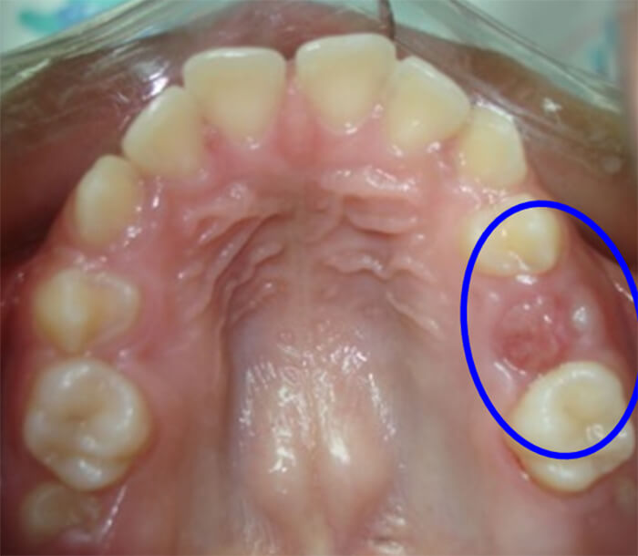 Fig. 15 Pérdida de espacio para el 14 por Pérdida Prematura del 54 Paciente Clínica Odontopediatría UGMA