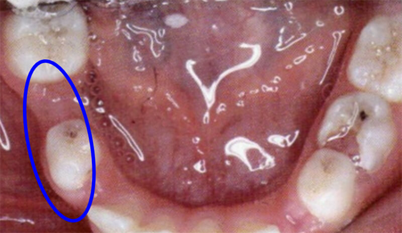 Fig. 16 Pérdida prematura del 85. Tomado de D' Escriván de Saturno. Ortodoncia en Dentición Mixta