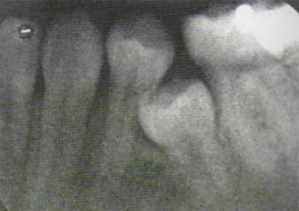 Fig. 17 Molar permanente migro y bloqueo la salida del segundo premolar. Tomado de D' Escriván de Saturno. Ortodoncia en Dentición Mixta