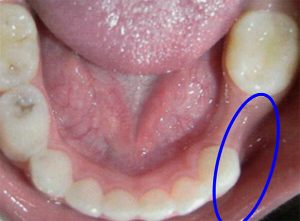 Fig. 18 Pérdida prematura del 85. Tomado de D' Escriván de Saturno. Ortodoncia en Dentición Mixta