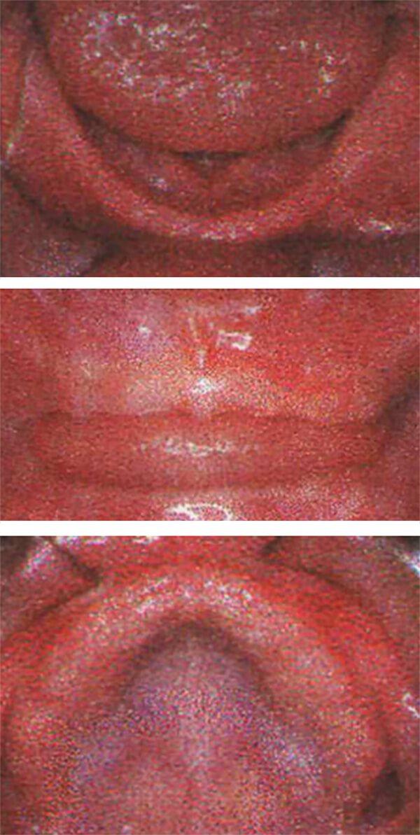 Fig. 19 Paciente con pérdida total de dientes temporales. Tomado de Clemente y col.