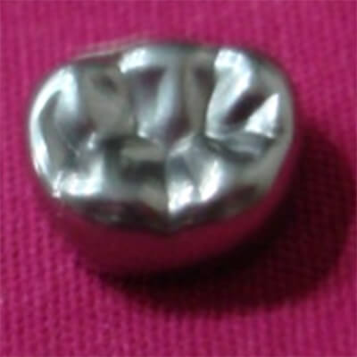 Fig. 20 Corona de acero inoxidable, para dientes temporales, cortesía de Dra. M. Farias de Hong