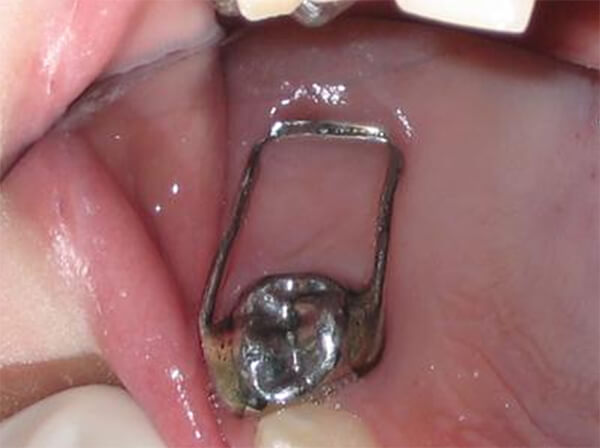 Fig. 25 Mantenedor de espacio en zapata distal en boca del paciente. Tomado de Esaú y col.