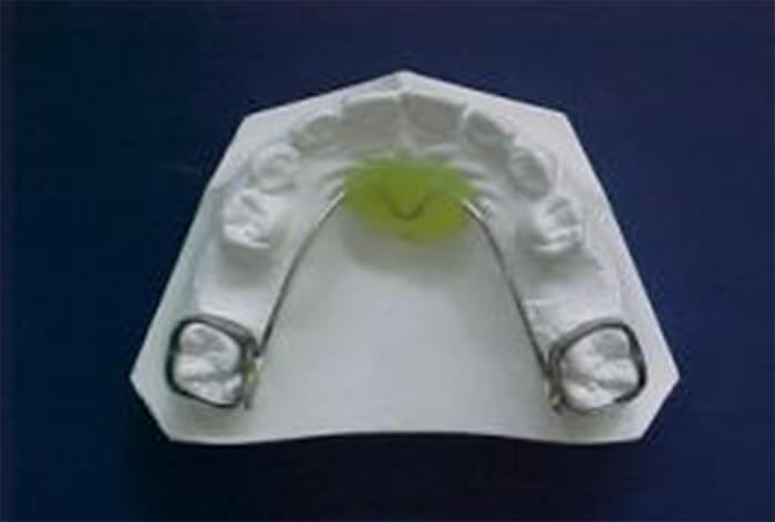 Fig. 28 Mantenedor de espacio en Barra transpalatina. Tomado de Guerrero y col.