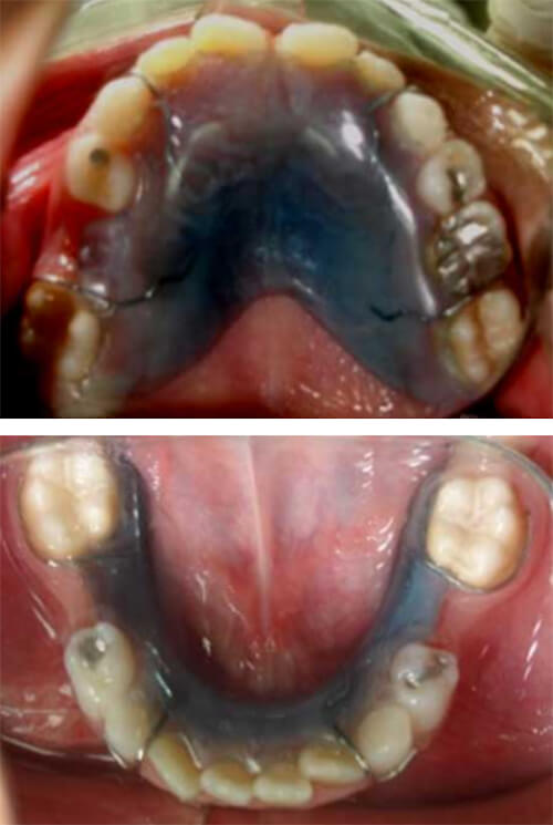 Fig. 29 Mantenedor de espacio removible Paciente Clínica Odontopediatría UGMA