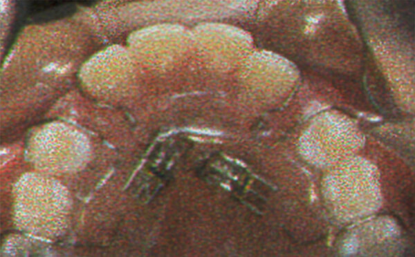 Fig. 32 Reganador de espacio con tornillo. Tomado de Clemente y col.