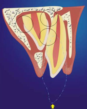 Fig. 1 Imagen representativa de la intrusión de un diente primario. Las zonas remarcadas indican las áreas con mayor probabilidad de injuria por el traumatismo. Fuente: Mendoza A.12