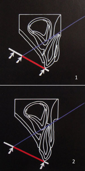 Fig. 4 Ilustración esquemática de la relación geométrica entre un incisivo primario intruido y el germen dental en desarrollo, y la imagen radiográfica resultante. 1: Si el diente primario está lejos del germen, la imagen radiográfica será acortada. 2: Si el diente primario está intruido hacia el germen dental, la imagen radiográfica será alongada. Fuente: Andreasen & cols. (2010).(6)