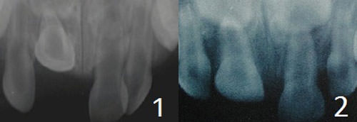 Fig. 5 Aspecto radiográfico de un diente primario intruido. 1. Luxación intrusiva del 51, se observa relación directa con el germen del diente permanente. Fuente: Gómes A. y cols. (2010).18 2. Luxación intrusivo del 51, en donde se observa el solapamiento de la punta del ápice con el germen del diente permanente, así como el acortamiento dentario, lo cual indica que el diente se encuentra ubicado en la cortical externa. Fuente: García C, Mendoza A. (2003).(5)