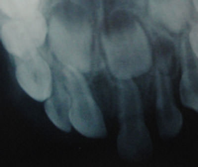 Fig. 6 Radiografía oclusal de un diente primario intruido. Fuente: García C, Mendoza A. (2003).(5)