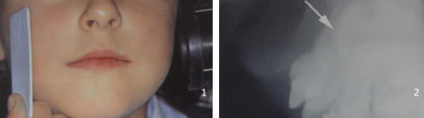 Fig. 7: 1: Colocación adecuada de la radiografía extraoral para obtener la imagen del perfil óseo y dentario maxilar. 2: Imagen obtenida donde se observa la distancia entre el ápice del diente primario y el germen del permanente. Fuente: García C, Mendoza A. (2003).(5)