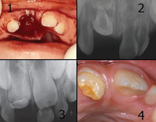Fig.8 Representación de caso de intrusión completa del 51 en niño de 14 meses con secuelas en dentición permanente. 1 Fotografía inicial el día del traumatismo donde se percibe la severidad de la intrusión. 2 Radiografía periapical de la zona en la cual se observa el 51 acortado y en relación directa con el germen del 11. 3 Radiografía periapical de la zona 4 años posterior al traumatismo donde se evidencian alteraciones en la corona del 11 previo a su erupción. 4 Fotografía del diente permanente erupcionado años más tarde del traumatismo, se comprueban las secuelas del traumatismo: hipoplasia, dislaceración de la corona y descoloración amarillenta en el 11. Fuente: Gómes A & cols. (2010). 18