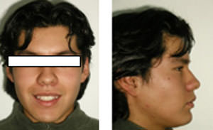 Figura 1 - Paciente de frente Figura 2 - paciente de perfil