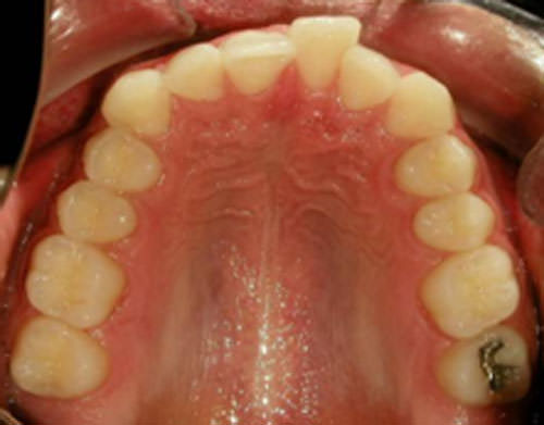 Figura 6 Oclusal superior