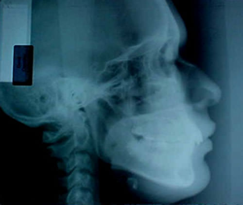 Figura 8 Radiografía lateral de cráneo inicio