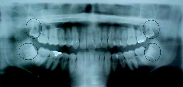 Figura 9 Radiografía panorámica de inicio, con los terceros molares terminando de formarse