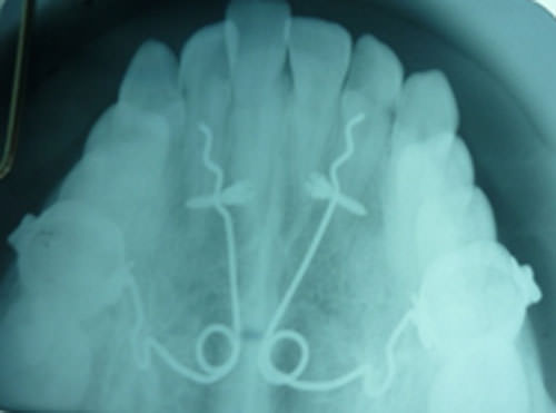 Figura 10 Radiografia oclusal control