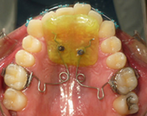 Figura 11 Intraoral oclusal superior