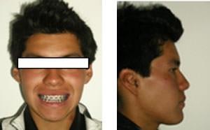 Figura 14 Foto de frente en sonrisa Figura 15 Fotografía de Perfil
