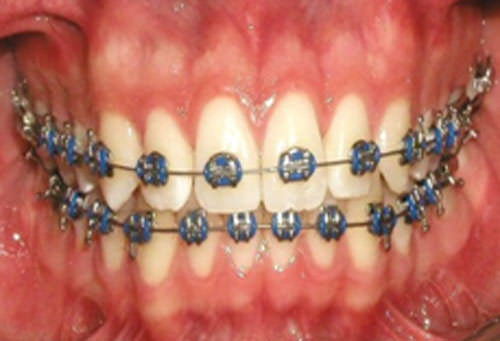 Figura 16 Intraoral frente