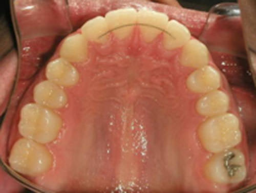 Figura 23 Oclusal Superior