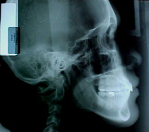 Figura 23 Radiografía lateral de cráneo