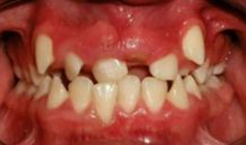 Fig.4 Foto intraoral de frente
