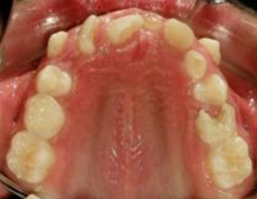 Fig 7 Foto oclusal superior