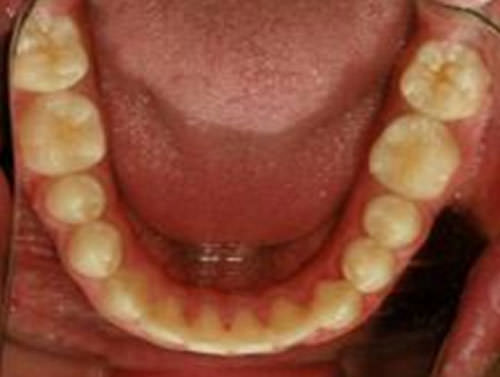 Fig 8 Foto oclusal inferior