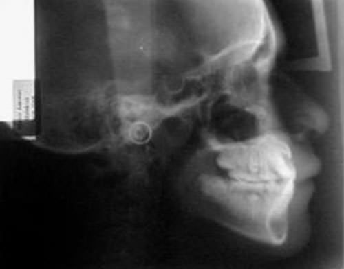 Fig 9 Radiografía lateral de cráneo