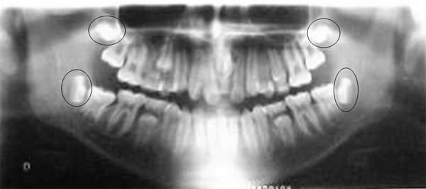 Fig 10 Radiografía Panorámica