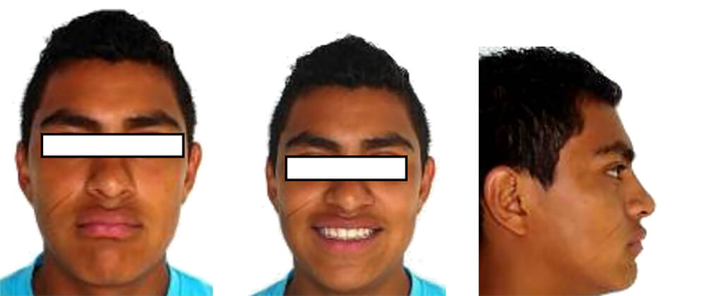 Fig. 16 Foto extaoral de frente Fig. 17 Foto de sonrisa Fig. 18 Foto de frente de perfil