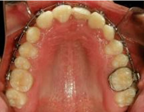Figura 14 Oclusal Superior