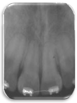 Figura 22 Rx periapical