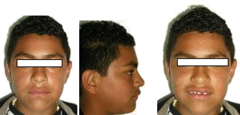 Fig.1 Foto extaoral de frente Fig.2 Foto de perfil Fig. 3 Foto de frente de sonrisa