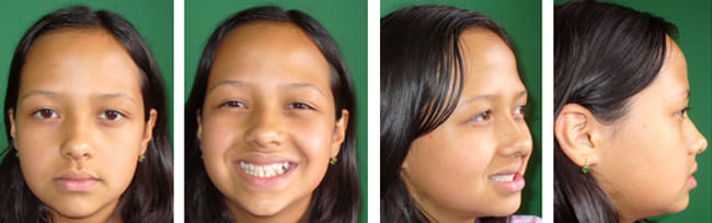 Fig. 1, 2, 3, 4 Fotografías extraorales iniciales.