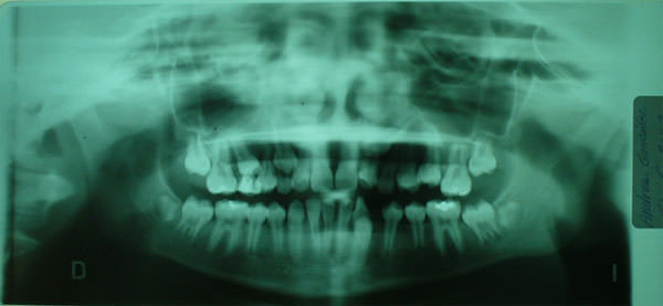 Fig. 8 Radiografía Panorámica inicial, nótese los caninos izquierdos incluidos.