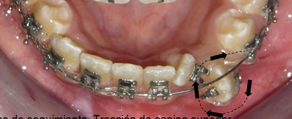 Fig. 9 y 10 Fotografías intraorales de seguimiento. Tracción de canino superior con ligadura metálica y correción de rotación de canino ionferior con cadena elastomérica.